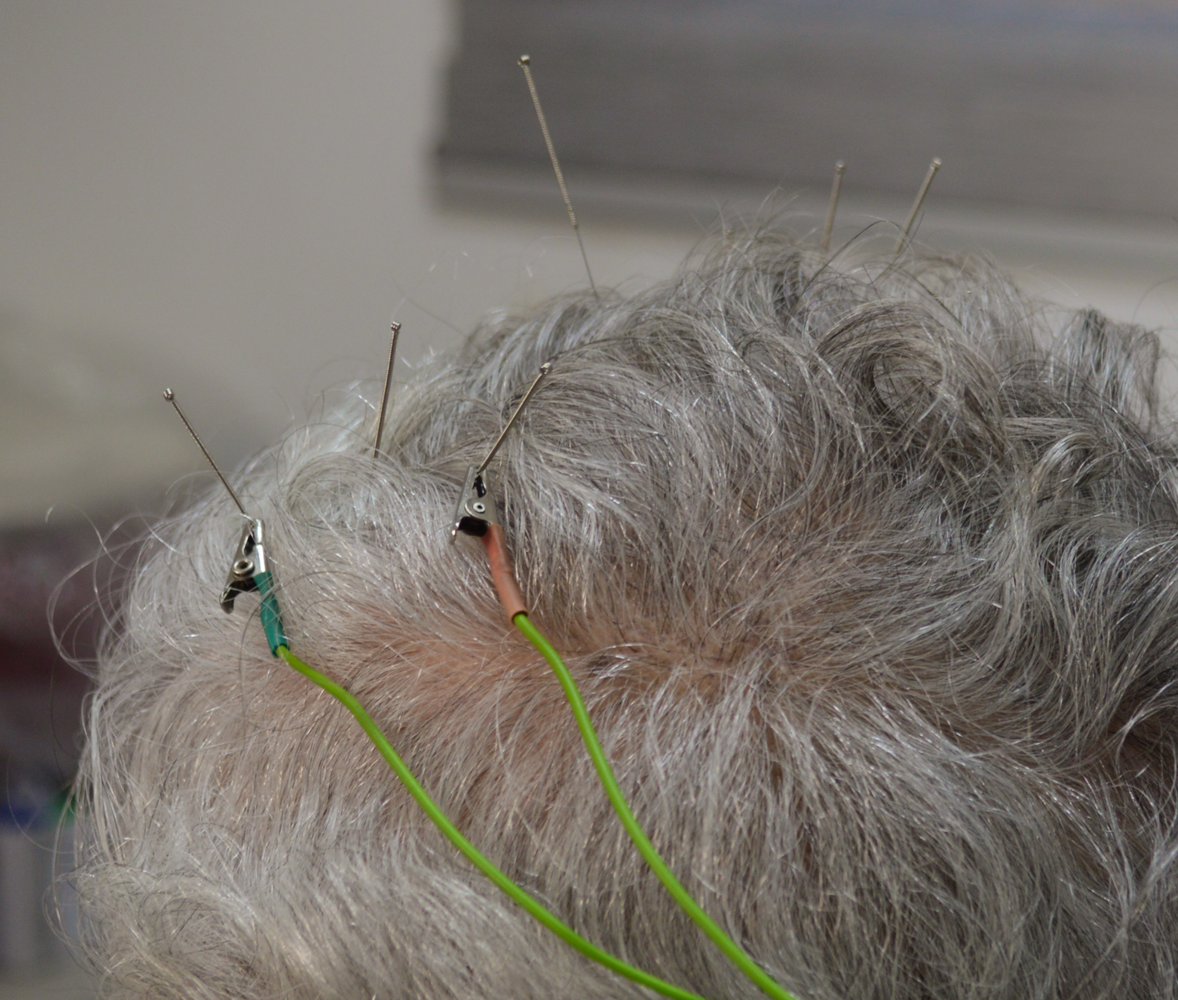 servicio acupuntura